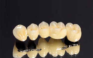 Metal Ceramic at GTR Dental Lab